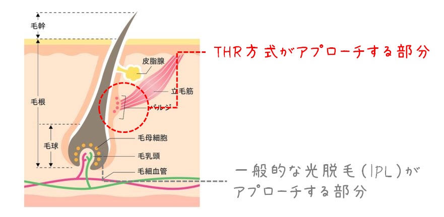 バルジ領域　IPLとTHR　アプローチ部分の違い　図解